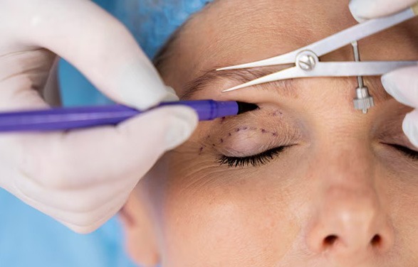 Blepharoplasty Surgery in ahmedabad